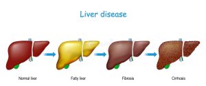 liver disease Rigenera il fegato e previeni le malattie più gravi Dottoressa Natura